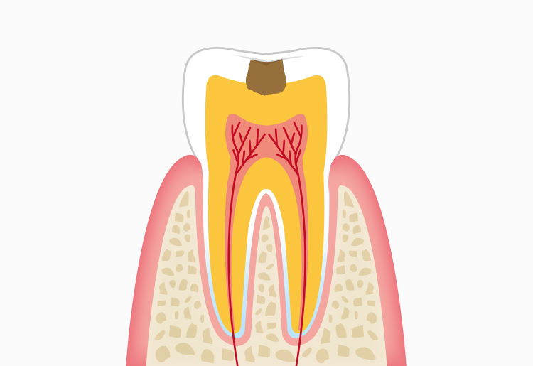 C2：象牙質に達した虫歯