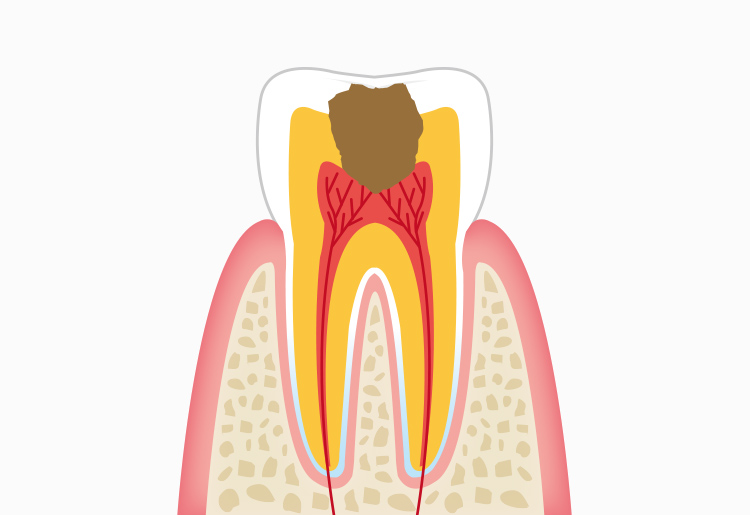 C3：歯髄(神経)に達した虫歯
