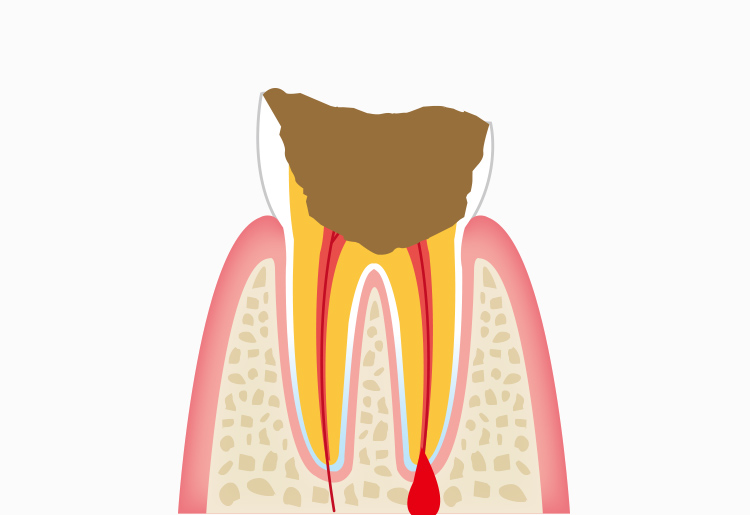 C4：歯質が失われた虫歯