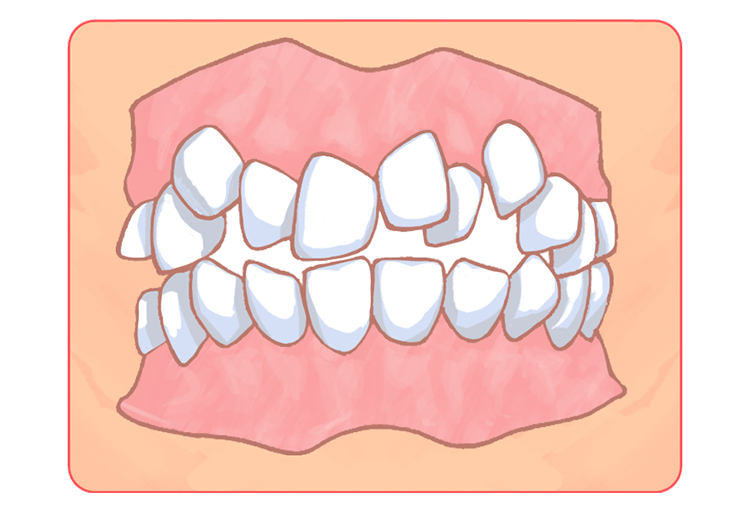 叢生・乱ぐい歯・八重歯