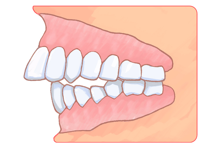 上顎前突（出っ歯）
