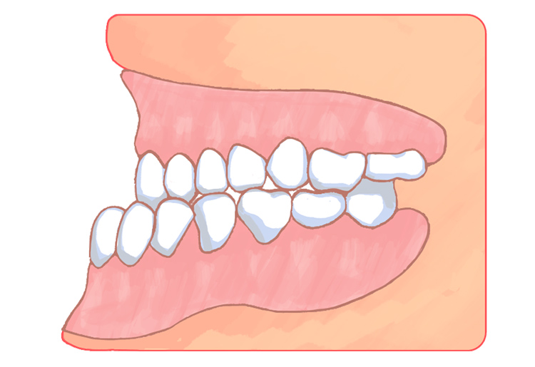 下顎前突（受け口