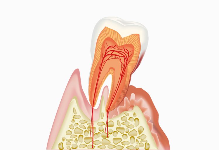 歯周病とは