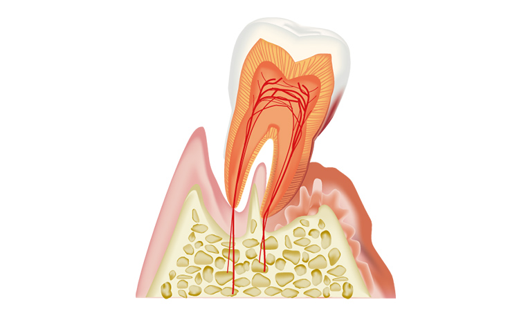 歯周病治療